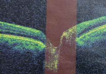 光干渉断層計(OCT)